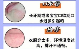 痤疮常识判断，痤疮如何判断