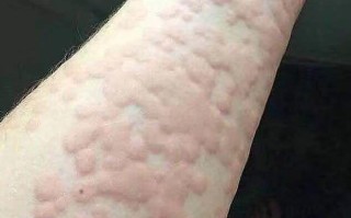 麻疹常识视频，麻疹小知识