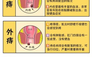 艾问常识痔疮（如何艾灸痔疮）
