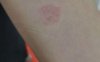 小孩背常识痒 - 孩子背痒