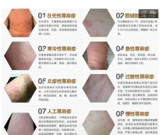 麻疹常识视频,麻疹小知识-第5张图片-牛逼常识网 麻疹常识视频,麻疹小知识-第5张图片-牛逼常识网