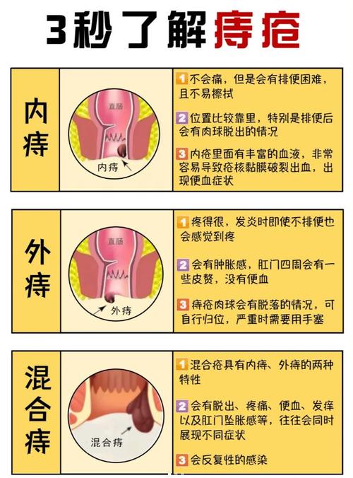 艾问常识痔疮(如何艾灸痔疮)-第1张图片-牛逼常识网 艾问常识痔疮(如何艾灸痔疮)-第1张图片-牛逼常识网