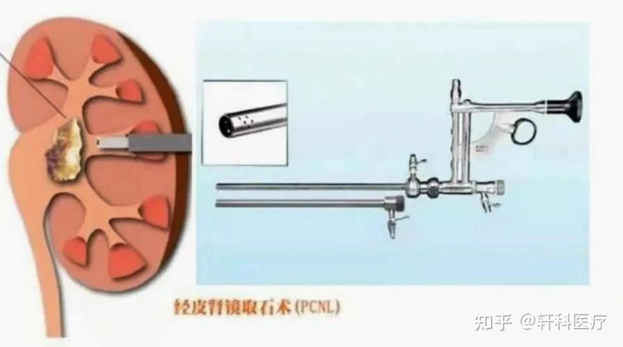 血管造瘘常识,血管造瘘原理-第2张图片-牛逼常识网 血管造瘘常识,血管造瘘原理-第2张图片-牛逼常识网