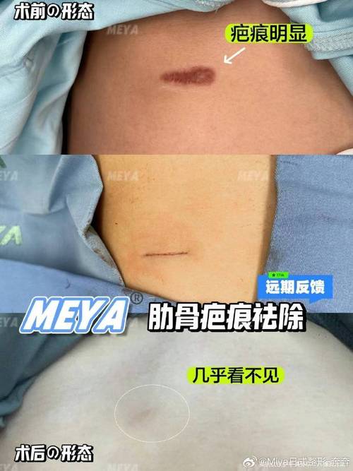 疤痕预防常识,疤痕预防需要注意什么-第2张图片-牛逼常识网 疤痕预防常识,疤痕预防需要注意什么-第2张图片-牛逼常识网