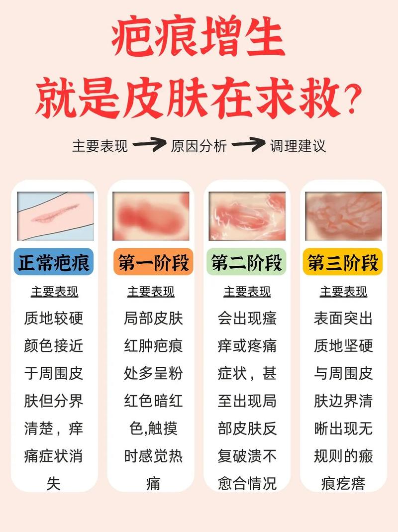 疤痕预防常识,疤痕预防需要注意什么-第3张图片-牛逼常识网 疤痕预防常识,疤痕预防需要注意什么-第3张图片-牛逼常识网
