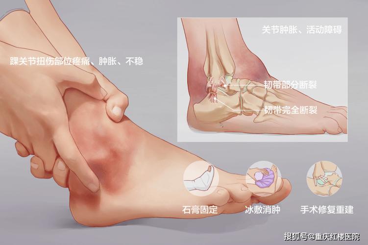 扭伤处理常识 - 扭伤处置方法-第4张图片-牛逼常识网 扭伤处理常识 - 扭伤处置方法-第4张图片-牛逼常识网