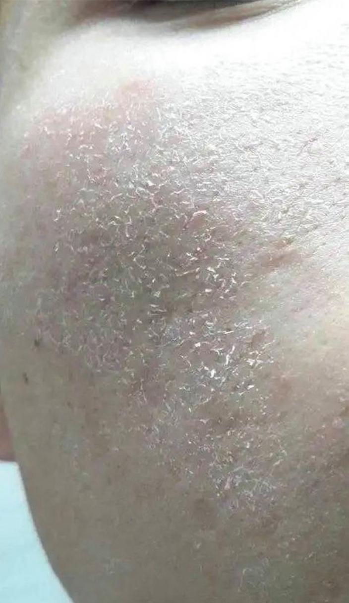 皮肤死皮常识 - 皮肤死皮常识图片-第7张图片-牛逼常识网 皮肤死皮常识 - 皮肤死皮常识图片-第7张图片-牛逼常识网