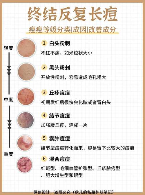 祛痘护肤常识(祛痘护肤知识)-第4张图片-牛逼常识网 祛痘护肤常识(祛痘护肤知识)-第4张图片-牛逼常识网