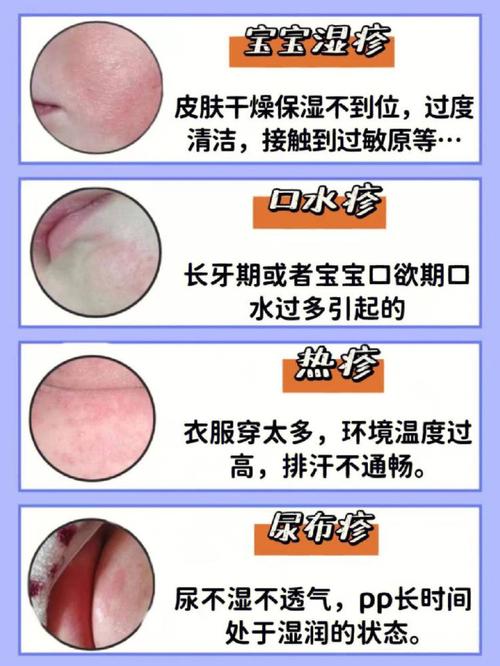 痤疮常识判断,痤疮如何判断-第2张图片-牛逼常识网 痤疮常识判断,痤疮如何判断-第2张图片-牛逼常识网
