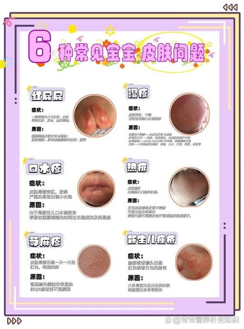 痤疮常识判断,痤疮如何判断-第3张图片-牛逼常识网 痤疮常识判断,痤疮如何判断-第3张图片-牛逼常识网