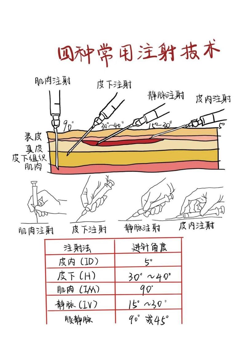静脉注射常识,静脉注射的操作要点和步骤-第8张图片-牛逼常识网 静脉注射常识,静脉注射的操作要点和步骤-第8张图片-牛逼常识网