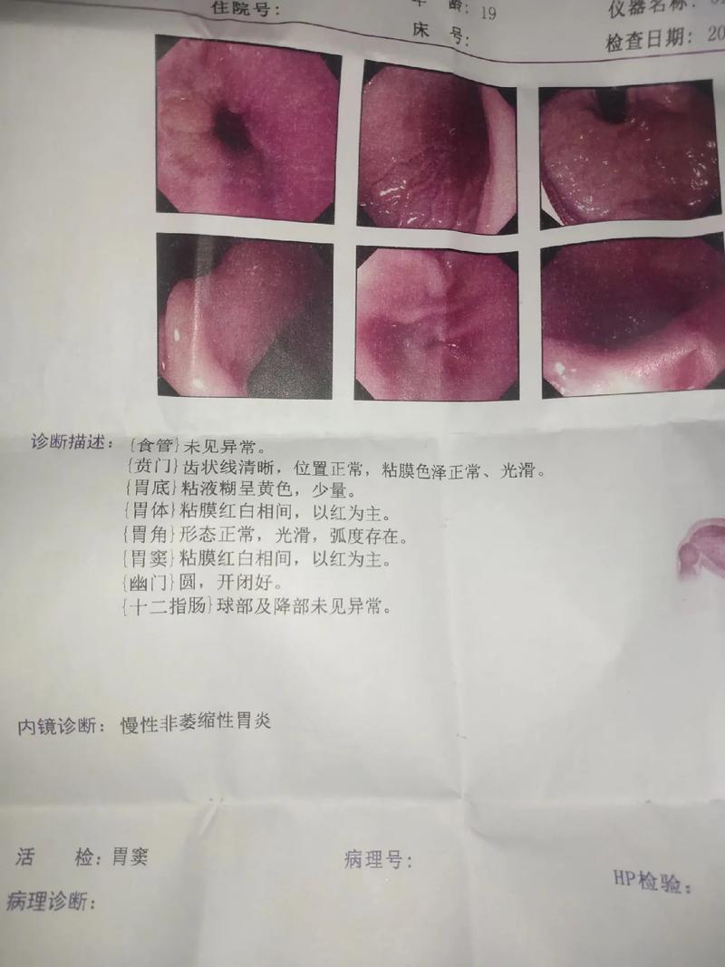 胃镜检查常识 - 胃镜检查事项-第4张图片-牛逼常识网 胃镜检查常识 - 胃镜检查事项-第4张图片-牛逼常识网
