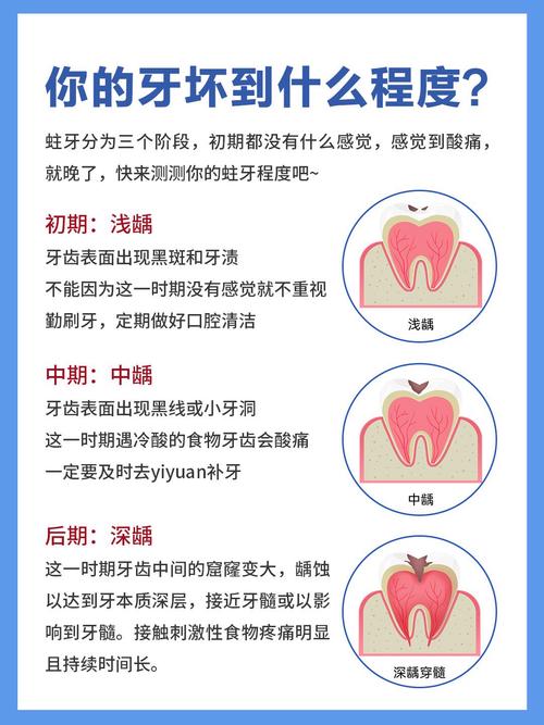 牙齿治疗常识 - 牙齿治疗方案-第4张图片-牛逼常识网 牙齿治疗常识 - 牙齿治疗方案-第4张图片-牛逼常识网