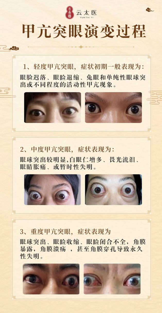 甲亢的小常识,甲亢的症状及危害应注意的事项-第7张图片-牛逼常识网 甲亢的小常识,甲亢的症状及危害应注意的事项-第7张图片-牛逼常识网