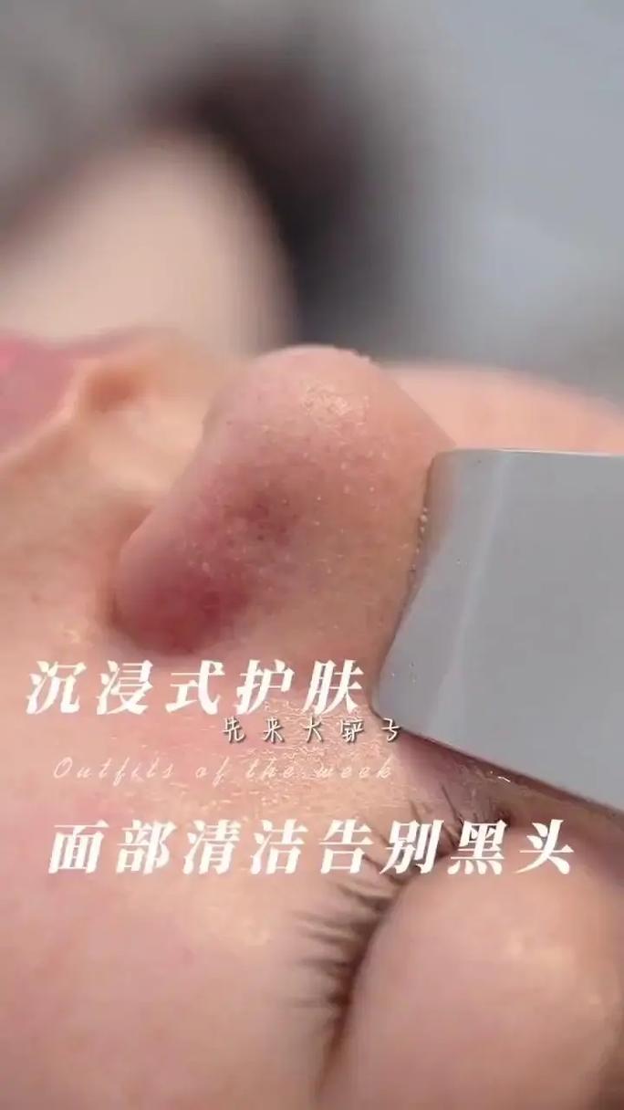 去黑头小常识 - 去黑头最简单的-第4张图片-牛逼常识网 去黑头小常识 - 去黑头最简单的-第4张图片-牛逼常识网