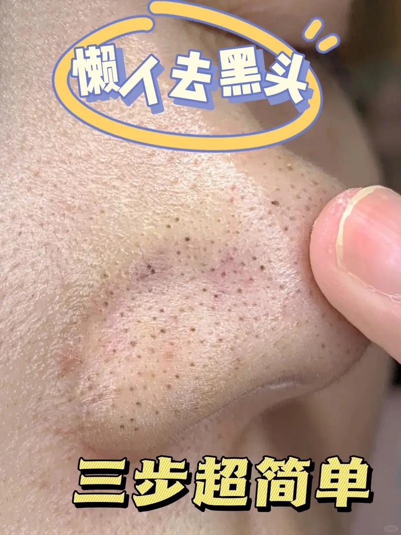 去黑头小常识 - 去黑头最简单的-第5张图片-牛逼常识网 去黑头小常识 - 去黑头最简单的-第5张图片-牛逼常识网