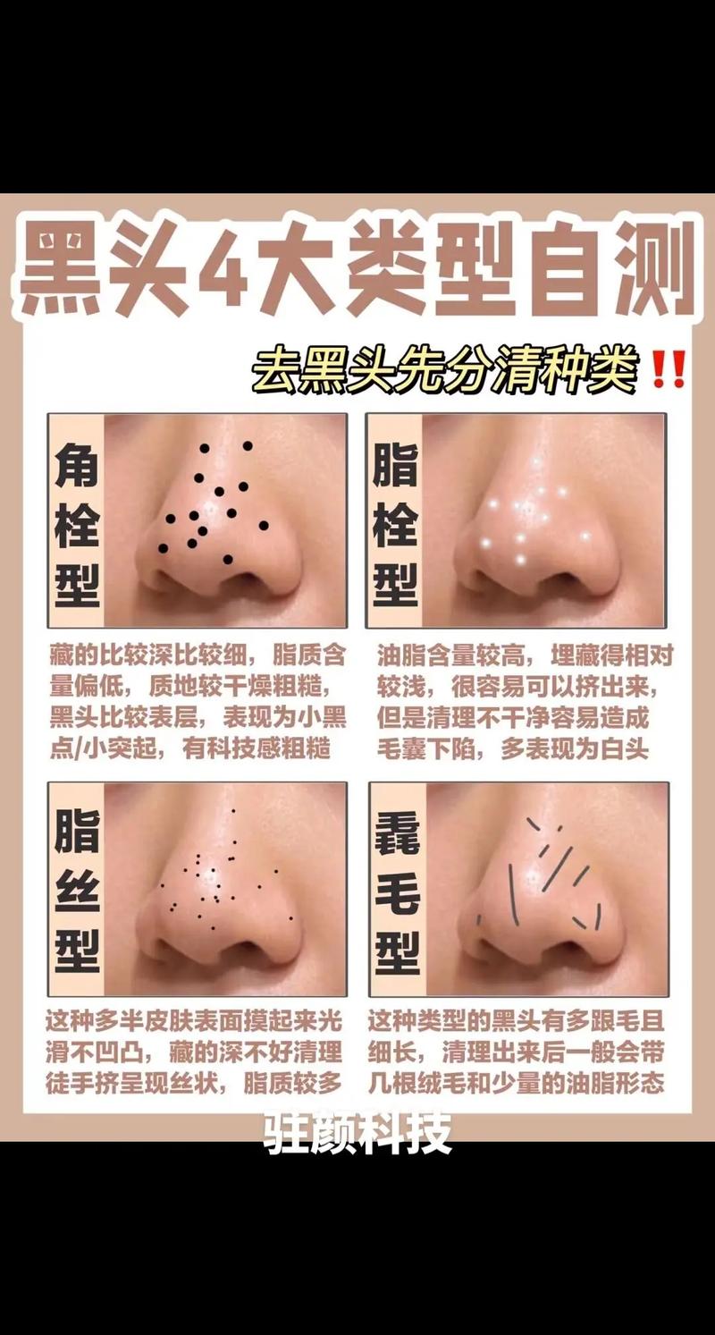 去黑头小常识 - 去黑头最简单的-第6张图片-牛逼常识网 去黑头小常识 - 去黑头最简单的-第6张图片-牛逼常识网