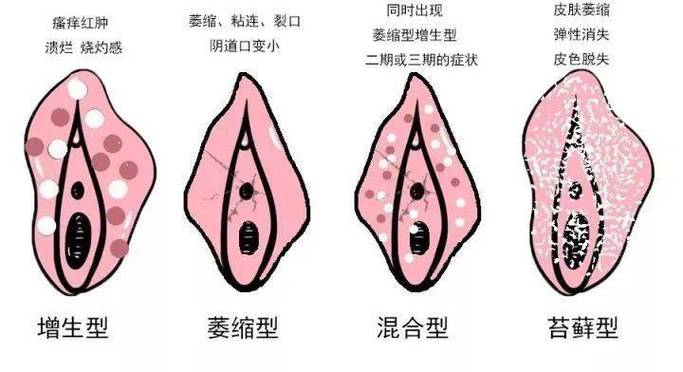 外阴护理常识的简单介绍-第3张图片-牛逼常识网 外阴护理常识的简单介绍-第3张图片-牛逼常识网